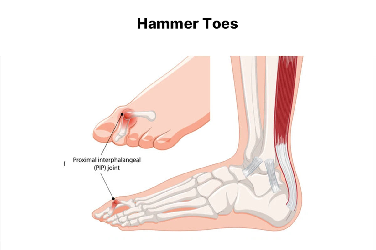 Comfortable men’s walking shoes for bunion pain